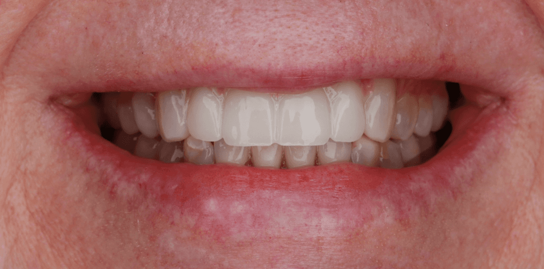 Cosmetic Bonding
