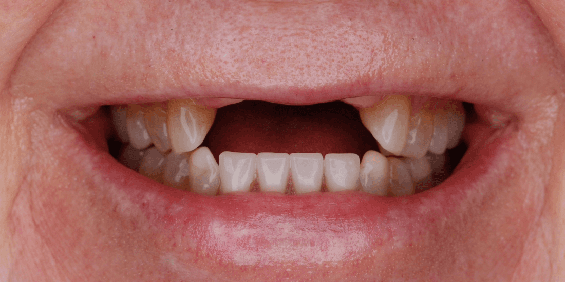 Missing Teeth