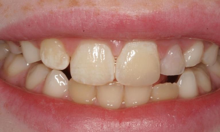 Tooth-Color-Resin-Composite-EMERGENCY-After-Image