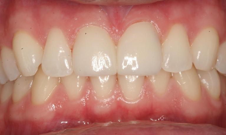 ZOOM-Teeth-Whitening-After-Image