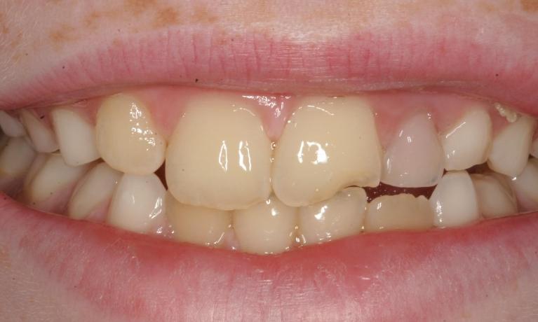 Tooth-Color-Resin-Composite-EMERGENCY-Before-Image
