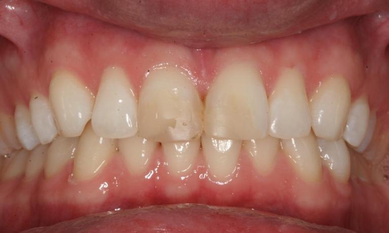 ZOOM-Teeth-Whitening-Before-Image