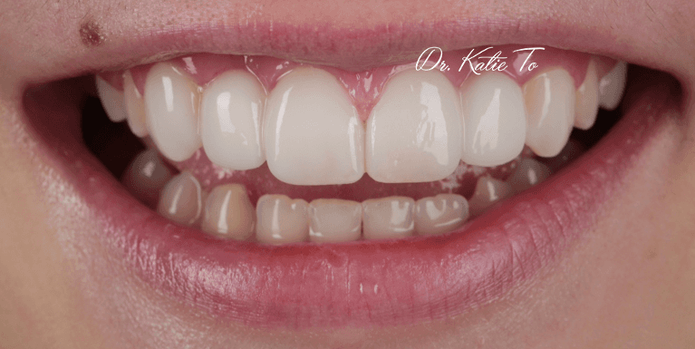 I-m-missing-teeth--SMILE-MAKEOVER-After-Image