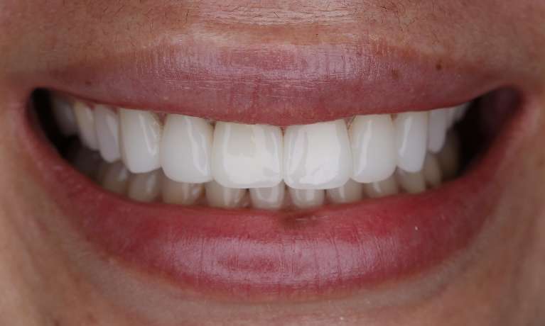 My-front-teeth-are-chipped-and-worn-down--COSMETIC-BONDING-After-Image