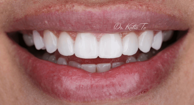 My-teeth-are-too-small-and-I-have-gaps--COSMETIC-BONDING-After-Image