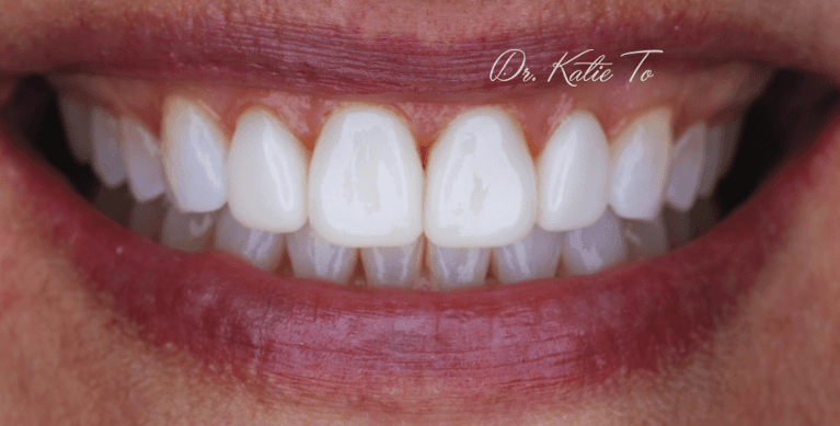 I-don-t-like-my-front-tooth--COSMETIC-BONDING-After-Image