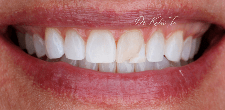 I-don-t-like-my-front-tooth--COSMETIC-BONDING-Before-Image