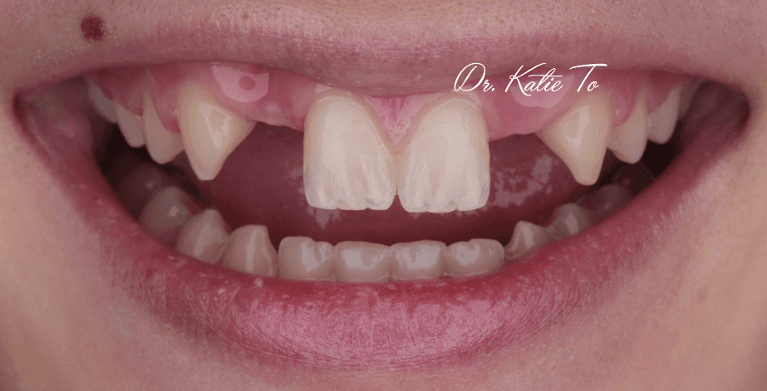 I-m-missing-teeth--SMILE-MAKEOVER-Before-Image