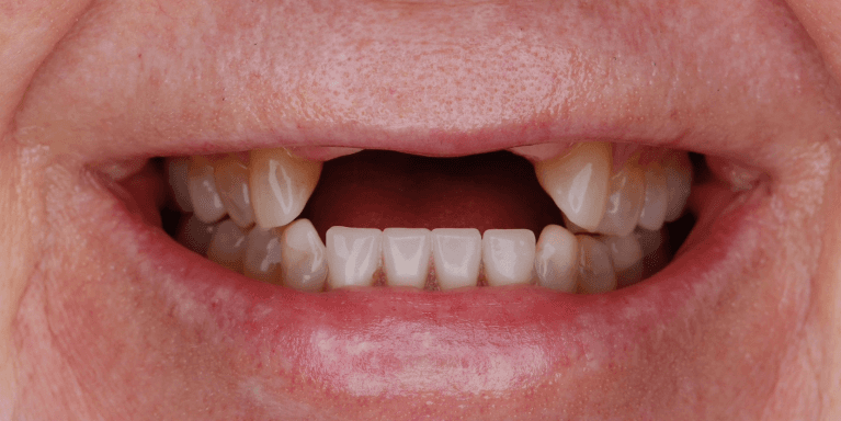 Missing Teeth