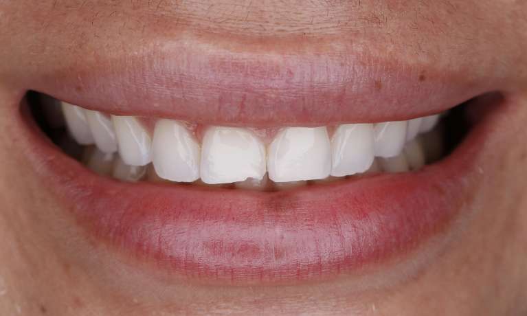 My-front-teeth-are-chipped-and-worn-down--COSMETIC-BONDING-Before-Image