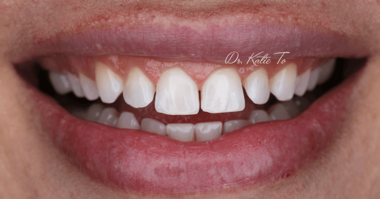 My-teeth-are-too-small-and-I-have-gaps--COSMETIC-BONDING-Before-Image